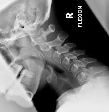 It's commonly done after someone has been in an automobile or other accident. The Cervical Spine