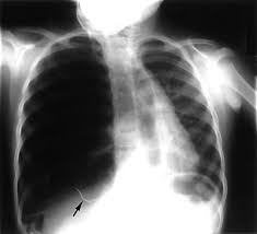 A pneumothorax can be caused by: A Strange Case Of A Tension Pneumothorax Emergency Medicine Journal