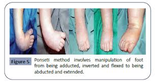 Clubfoot is a birth defect where one or both feet are rotated inward and downward. Club Foot Treatment In Bangladesh