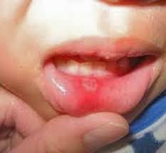 15 Home Remedies For Mouth Ulcer In The Worst Cases Some Mouth Sores Can Prevent A Person From Compl Mouth Ulcer Home Remedy Ulcer Remedies Mouth Mouth Ulcers