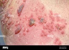 Image result for Varicella zoster on human skin