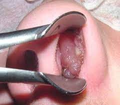 A Man With A Blocked Nose The Bmj