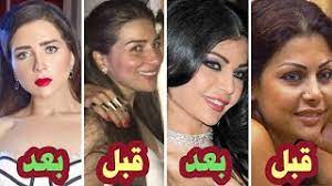 وهل يوجد مساج للأنف بعد عملية التجميل أو تمارين لتقليل هذا التورم. Ø²ÙŠÙ† ÙƒØ±Ø²ÙˆÙ† Ù‚Ø¨Ù„ Ø¹Ù…Ù„ÙŠØ§Øª Ø§Ù„ØªØ¬Ù…ÙŠÙ„ Ù…ÙˆØ³ÙŠÙ‚Ù‰ Ù…Ø¬Ø§Ù†ÙŠØ© Mp3