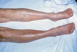 Trombocitopenia Imunitaria Tpi Hematologia E Oncologia Manuais Msd Edicao Para Profissionais