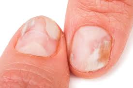 Fingernagelpilz Behandeln Das 1 Mittel Juni 2021