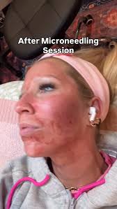 ✨ Microneedling: What to Expect ✨, New here? We’ve got you 🤍, • Numbing  cream for comfort, • Light redness after (like a mild sunburn), • Minimal  downtime (24–72 hrs), • Smoother, brighter skin in ...