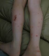 Learn more about the schools, student. Vegmom Moments The Chiggers Update