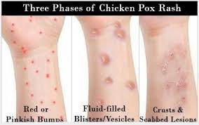 Hal ini merupakan pertanda kalau kamu akan bertemu dengan seseorang yang sudah lama kamu harapkan. Chicken Pox Besar