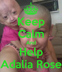 Adalia rose williams, from round rock, texas, suffers from a rare condition called progeria which is making her tiny body age several times faster than normal. Keep Calm And Help Adalia Rose Poster Jessica Tilley Keep Calm O Matic