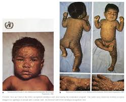 Image result for Smallpox
