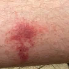 Image result for dermatitis contacta allergica