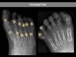 Image result for Supernumerary Digit