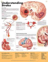 understanding stroke chart 20x26 medical anatomy medical