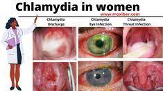 Female pictures of chlamydia in the eye. 31 Chlamydia Infection Ideas Infections Sexually Transmitted Diseases Std Symptoms