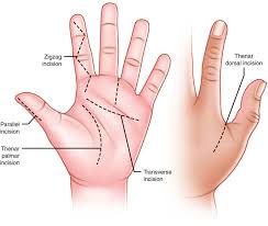Image result for Hand Infection