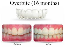 How does an overbite look like. Invisalign Dentist Rancho Cucamonga