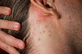 A psoríase é uma doença crónica de natureza inflamatória bastante frequente em todo o mundo. Tratamento Certo Livra 80 Dos Pacientes Das Lesoes De Psoriase