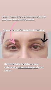 Ontem foi dia de deixar nossa enfermeira @savanadalagnol mais ainda..  Cicatriz “escondida” na dobra natural de pele para ficar o mais natural  possível.. Reparo de cicatriz inestética da infância