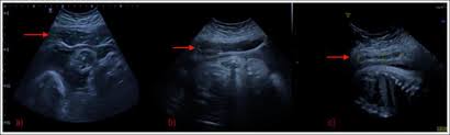 Obstetrics & gynaecology obstetrics & gynaecology. Spontaneous Rectus Sheath Hematoma In Pregnancy A Case Report Journal Of Obstetrics And Gynaecology Canada