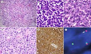 Image result for Ewing Sarcoma