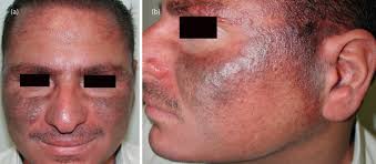 Generalizability of results is limited to african american females. Isotretinoin Induced Facial Hyperpigmentation Idiosyncratic Reaction Isotretinoin Induced Facial Hyperpigmentation Idiosyncratic Reaction Open Access Pub