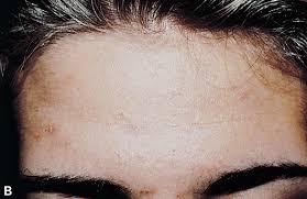 Image result for verrucae filiformes