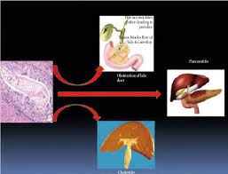 Fasciola hepatica (the common liver fluke or sheep liver fluke), which causes fascioliasis and typically infects sheep and cattle. Complications Of O Viverrini Liver Fluke Download Scientific Diagram
