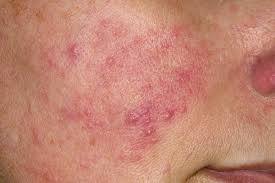 Image result for red rash face