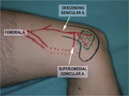 The medial femoral condyle vascularized bone flap is a versatile option, with simple dissection and relatively constant anatomy for reconstruction of musculoskeletal injuries.its irrigation from the descending genicular artery (or the superior medial genicular artery if the descending genicular artery is absent) allows transfer of the. Vascularised Corticoperiosteal Grafts From The Medial Femoral Condyle For Difficult Non Unions Of The Upper Limb Sciencedirect