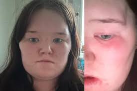 Dementia patient's hair 'butchered' in hospital without consent as police  launch probe