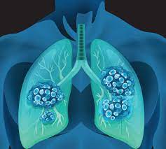 Find out more about her lung cancer symptoms and treatment. This Woman Thought She Had Pneumonia But Had Lung Cancer Health Com
