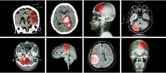 Découvrez les collections de vêtements pour. Tumeurs Cerebrales Inoperables Un Nouvel Espoir