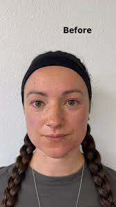 Unlock Long-Lasting Laser Results with Effective Post-Treatment Skincare  Routine