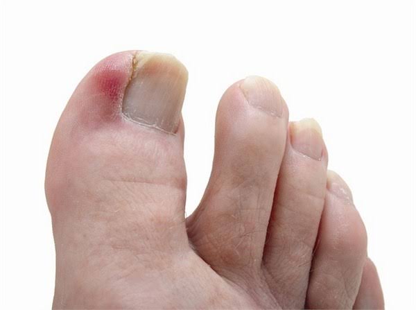 Làm gì khi bị chín mé, AloBacsi ơi?