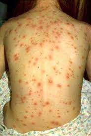 Image result for shingles in children
