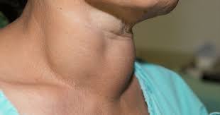 Image result for Goiter