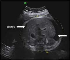 Before pleural ultrasound, a respiratory expert (gh) reviewed each patient's most recent chest radiographs to determine which side of the thorax to assess via ultrasound. Late Onset Fetal Bilateral Pleural Effusions Associated With Down Syndrome Sciencedirect