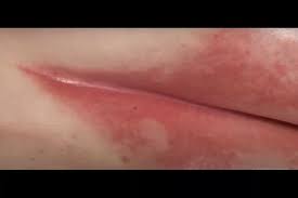 Image result for Intertrigo under breasts