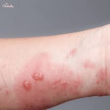 Image result for scabies human bites