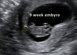 Why scan at 7 weeks? Dating Scan At 8 Weeks