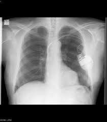 Pin On Chest Radiology