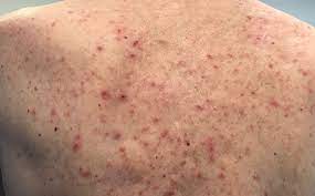 Check spelling or type a new query. Is My Skin Rash A Covid 19 Symptom