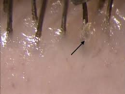 Image result for Demodex brevis