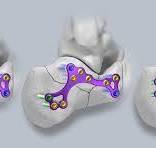 Gorilla® Calc Fracture Plating System – Paragon 28