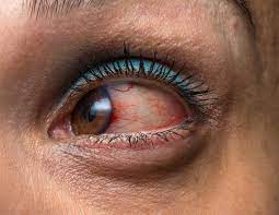 Oct 23, 2020 · symptoms. Glaucoma Symptoms