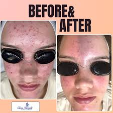 Reviews of Clear Beauty Acne Clinic