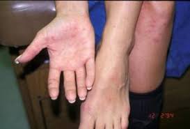 In chicken pox, the varicella zoster virus produces groups of many vesicles, each like a drop of water on a reddened base on the trunk, face, extremities and inside of the mouth. Viral