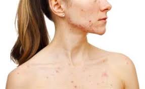 Due to the omnipresence of dioxins, all people have background exposure, which is not expected to affect human health. Was Ist Akne Welche Arten Es Gibt 14 Tipps Zur Behandlung