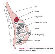 Coughing up mucus or blood. Breast Cancer Treatment Signs Symptoms Diagnosis And Staging