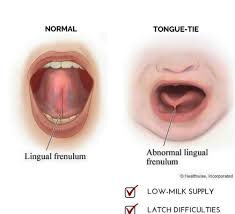Image result for Ankyloglossia